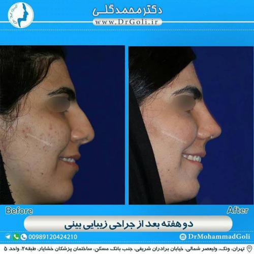 جراحی زیبایی بینی 340
