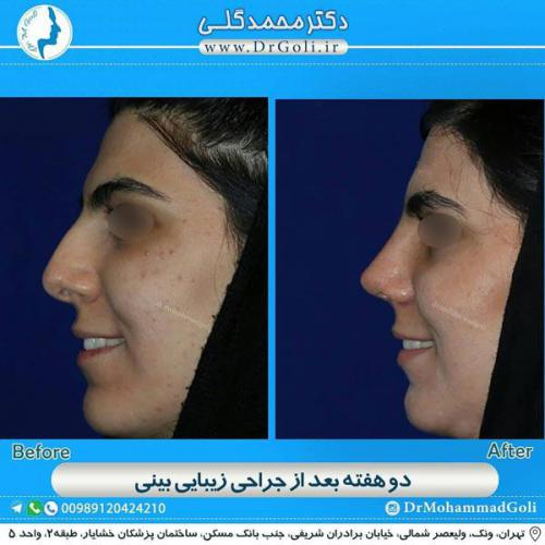 جراحی زیبایی بینی 341
