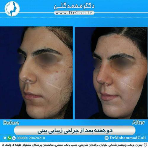 جراحی زیبایی بینی 342