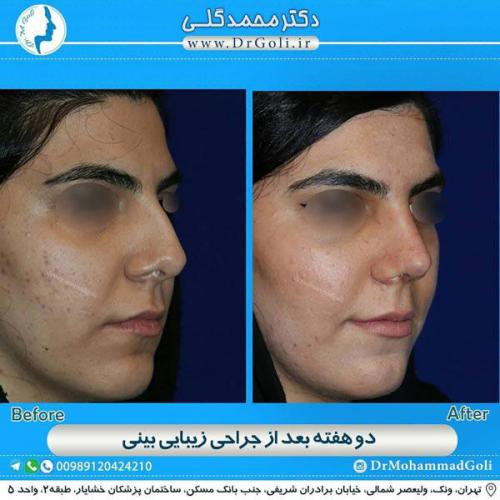 جراحی زیبایی بینی 343