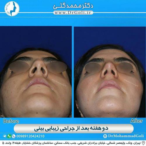 جراحی زیبایی بینی 344