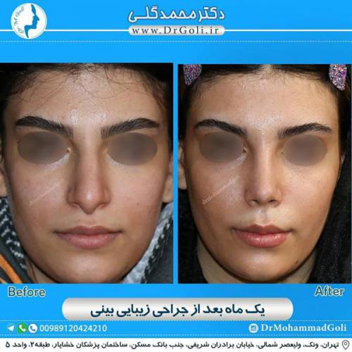 جراحی زیبایی بینی 345