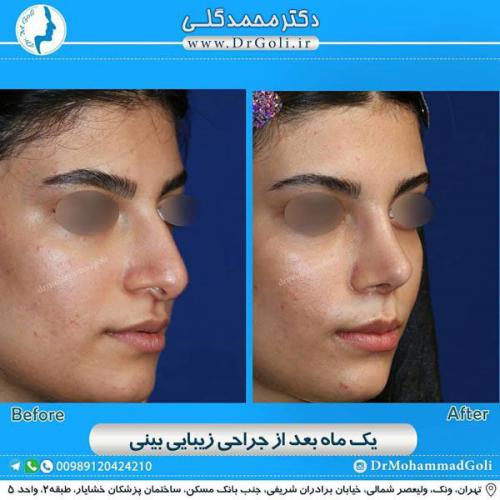 جراحی زیبایی بینی 346