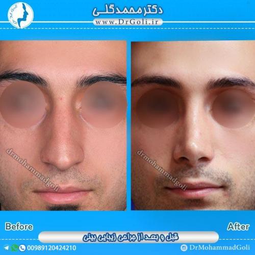 جراحی زیبایی بینی 37