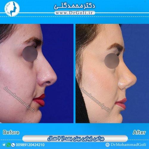 جراحی زیبایی بینی 38
