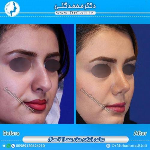 جراحی زیبایی بینی 39