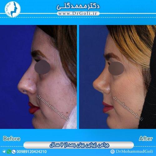 جراحی زیبایی بینی 40
