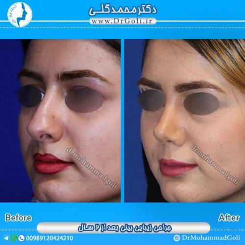 جراحی زیبایی بینی 41