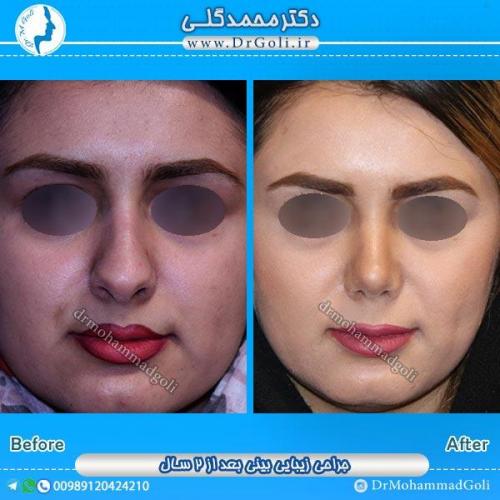 جراحی زیبایی بینی 42