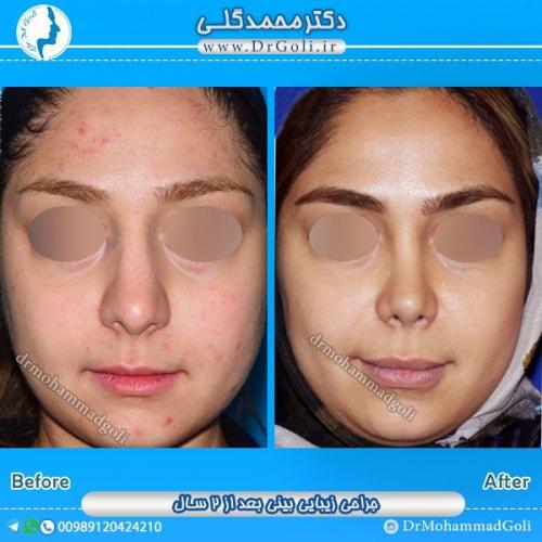 جراحی زیبایی بینی 43