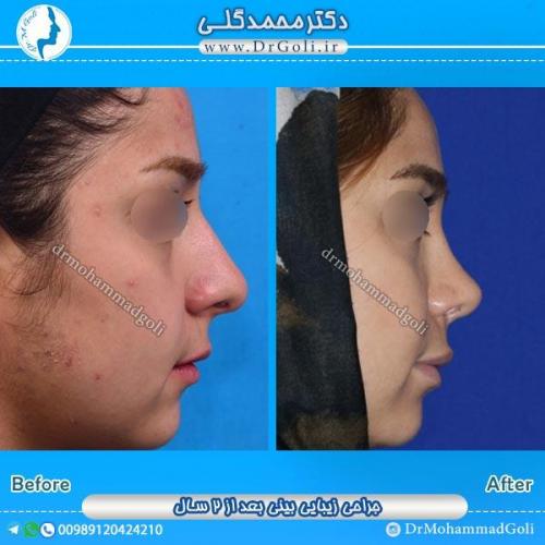 جراحی زیبایی بینی 44
