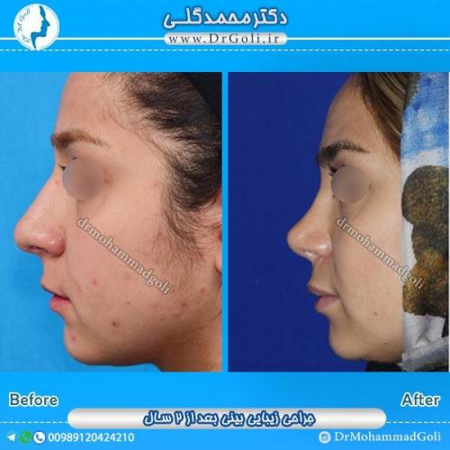 جراحی زیبایی بینی 45