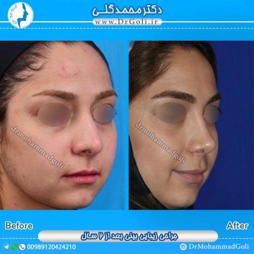 جراحی زیبایی بینی 46