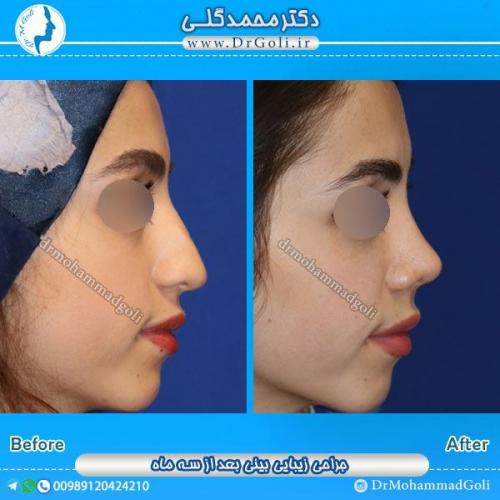 جراحی زیبایی بینی 47