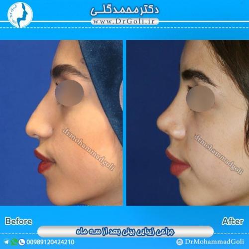جراحی زیبایی بینی 48