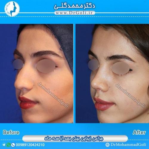 جراحی زیبایی بینی 50