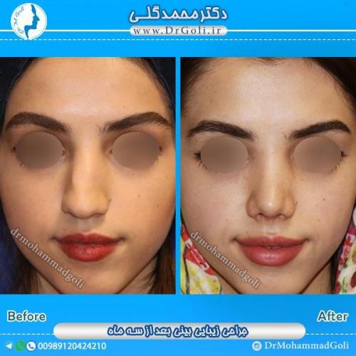 جراحی زیبایی بینی 51