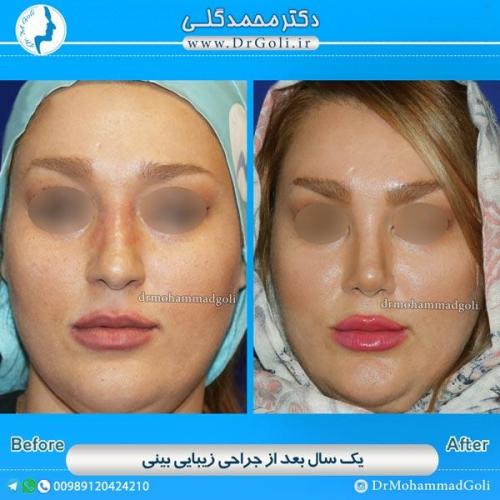 جراحی زیبایی بینی 52
