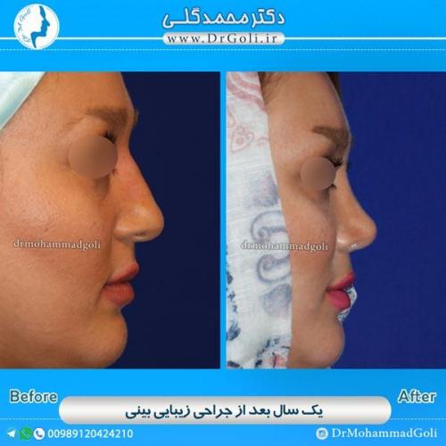 جراحی زیبایی بینی 53