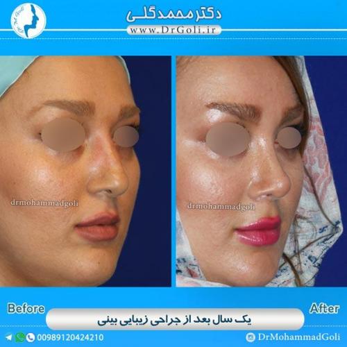 جراحی زیبایی بینی 54