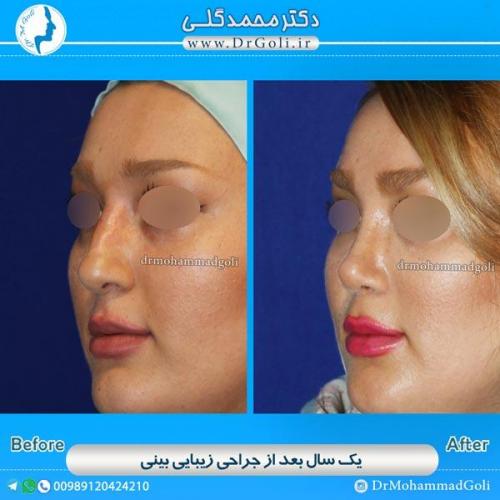 جراحی زیبایی بینی 55