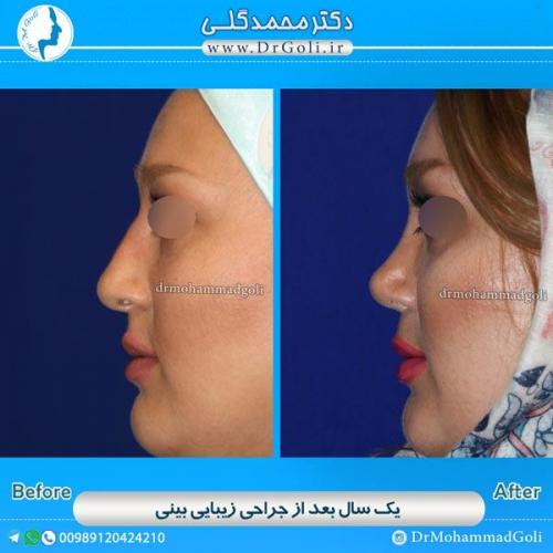 جراحی زیبایی بینی 56