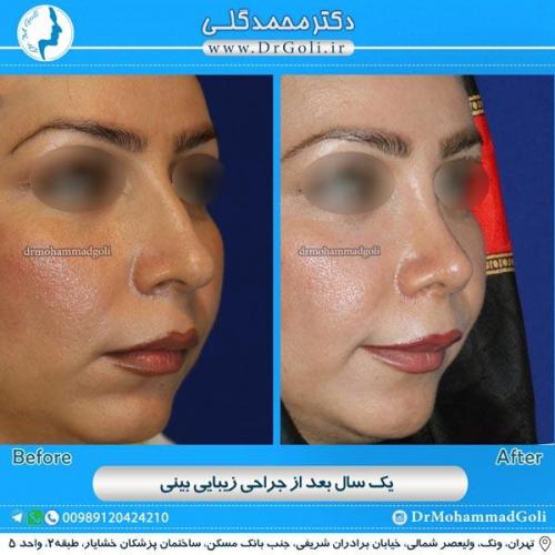 جراحی زیبایی بینی 80
