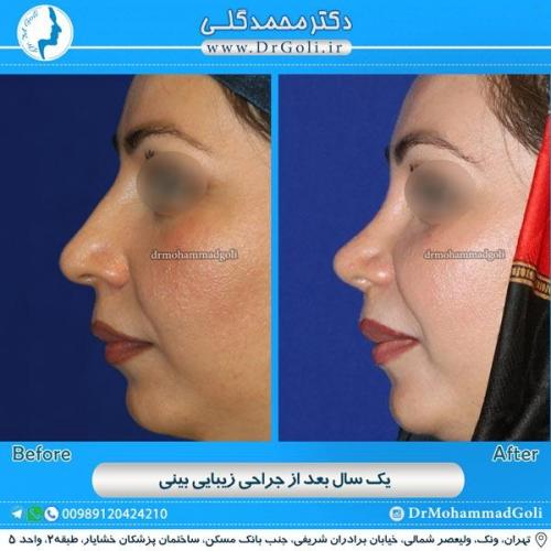 جراحی زیبایی بینی 81