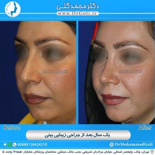 جراحی زیبایی بینی 82