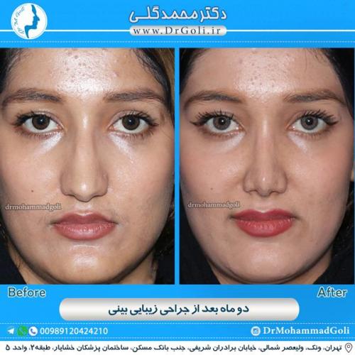 جراحی زیبایی بینی 83