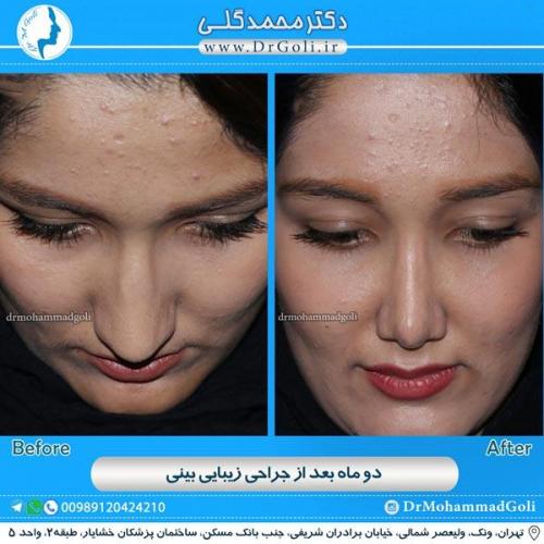 جراحی زیبایی بینی 84