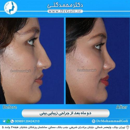 جراحی زیبایی بینی 85