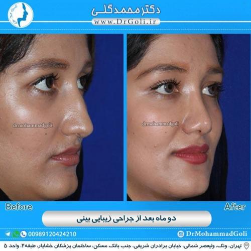 جراحی زیبایی بینی 86