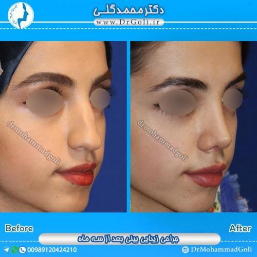 جراحی زیبایی بینی 87
