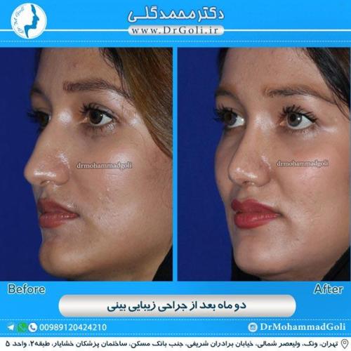 جراحی زیبایی بینی 88