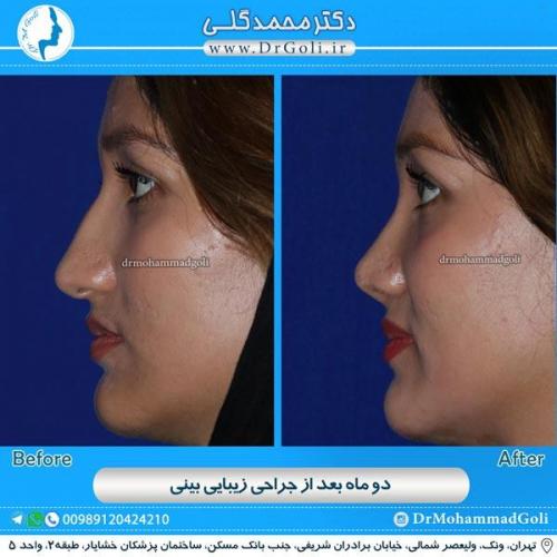 جراحی زیبایی بینی 89